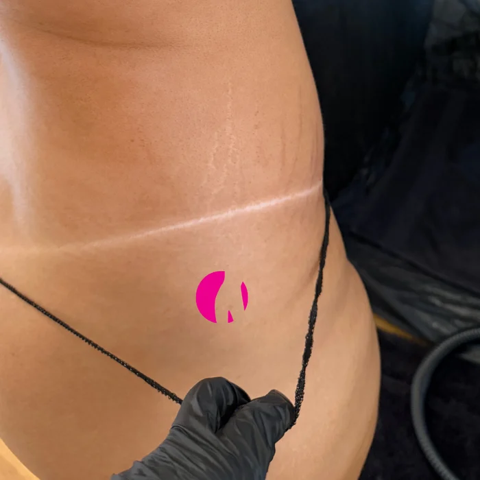 Feine Bräunungslinie an der Taille nach dem Spray Tan